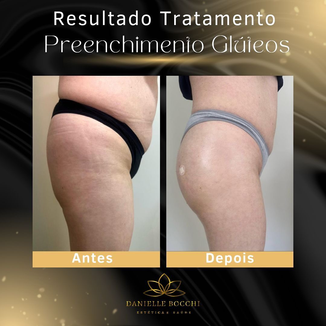 Antes e depois do preenchimento de glúteos