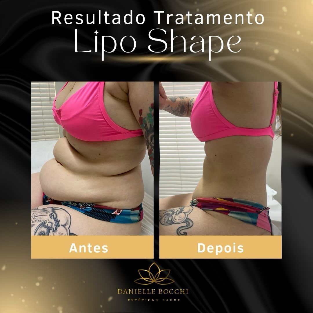 Antes e depois do tratamento Lipo Shape